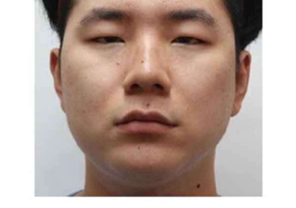 A_26_year_old_man_presented_with_a_typical_Asian_eye_puffiness_of_the_upper_eyelid_and_Q320.jpg